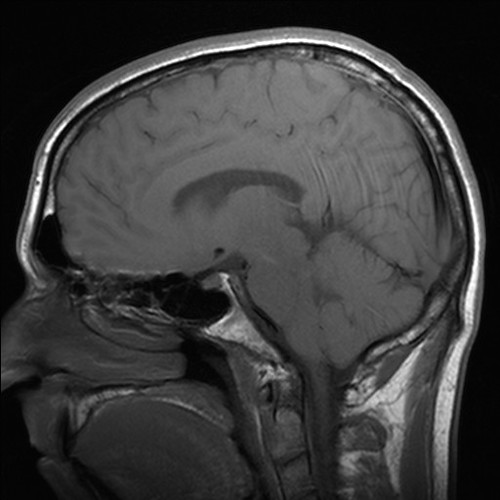 A medical scan of a brain injury