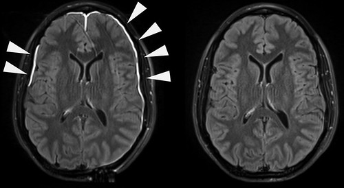 Image of a Brain Scan showing traumatic brain injury by NIH